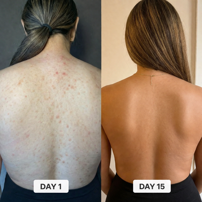 BacneErase™ Body Cleanser
