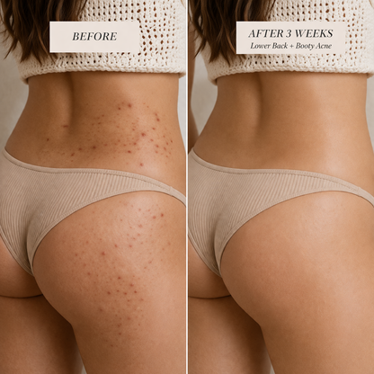 BacneErase™ Body Cleanser
