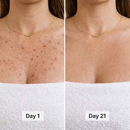 BacneErase™ Body Cleanser